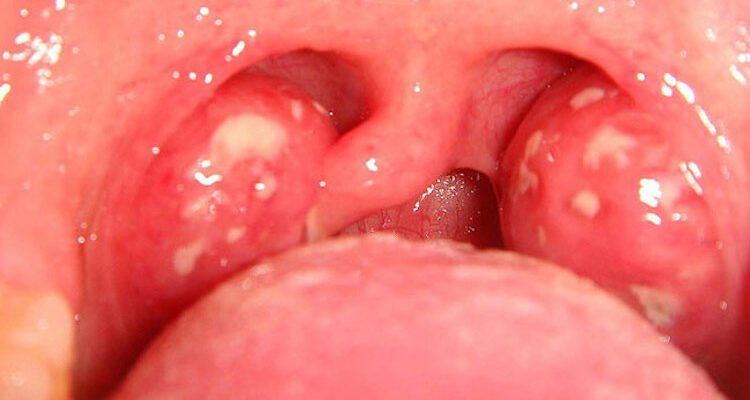 Що робити, коли болить горло і важко ковтати: народні методи