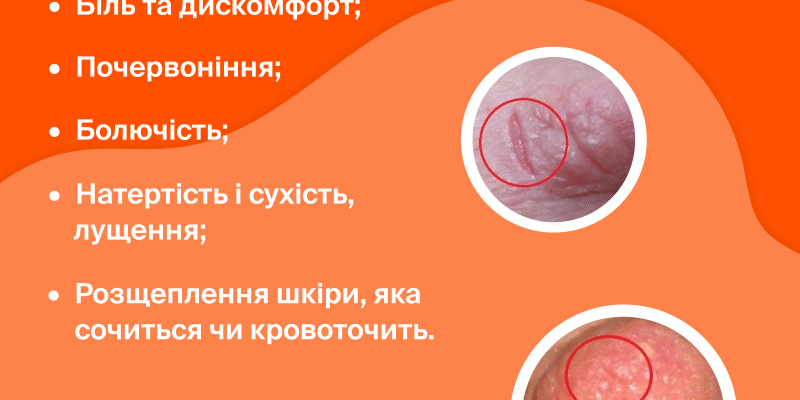Народні методи від тріщин на сосках: дієві поради для мам