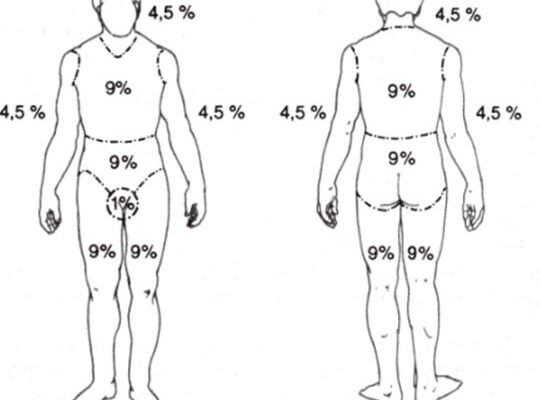 Оптимальні методи для визначення площі опіків: огляд основних підходів