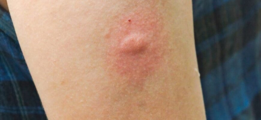 Як виглядає укус павука: ознаки, симптоми та перша допомога Як виглядає укус павука: ознаки, симптоми та перша допомога