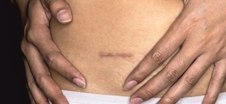 Як позбутися спайок в домашніх умовах: ефективні поради та методи