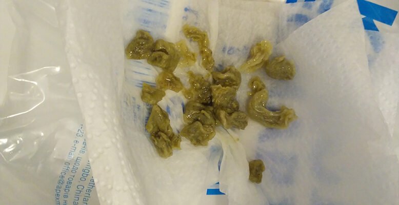 Як виглядають аскариди в калі: ознаки та діагностика паразитів