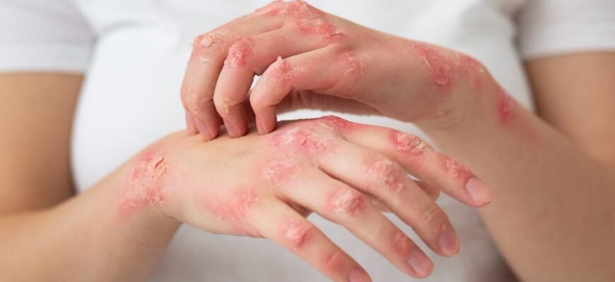 Атопічний дерматит: ефективні народні методи лікування вдома