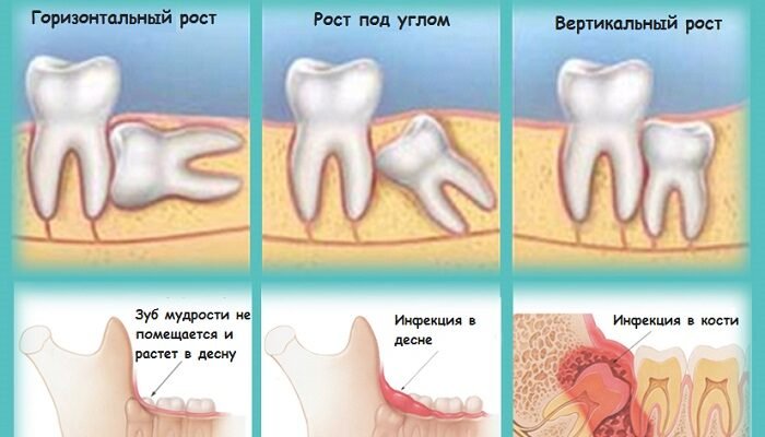 Як видалити зуб мудрості: поради та інструкції від стоматолога