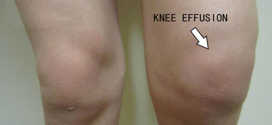 Ефективні народні методи для лікування рідини в коліні: поради та рецепти