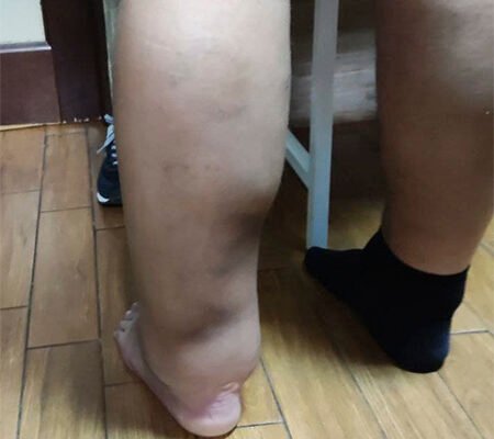 Лімфостаз нижніх кінцівок: ефективні народні методи лікування