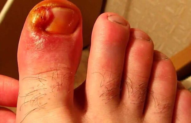 Нариває палець на нозі: ефективні народні методи лікування