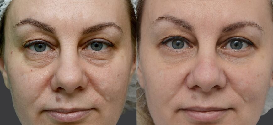 Ефективні народні методи проти чорних кругів під очима: поради та рецепти