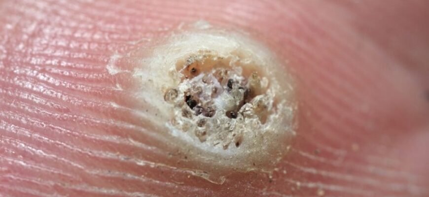 Як виглядає бородавка: зовнішні ознаки та методи визначення