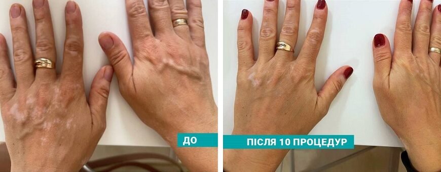 Сучасні методи лікування вітіліго: ефективні підходи та новинки 2023