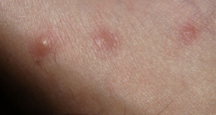 Як виглядає укус пилового кліща: ознаки та симптоми реакції шкіри