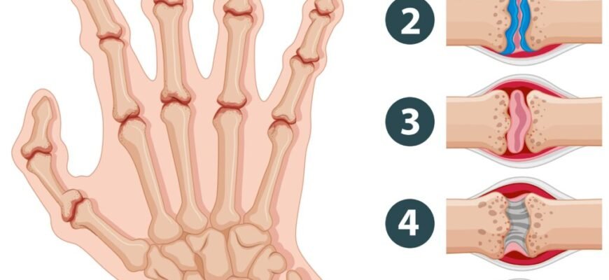 Запалення суглобів пальців рук: ефективні народні методи лікування Запалення суглобів пальців рук: ефективні народні методи лікування