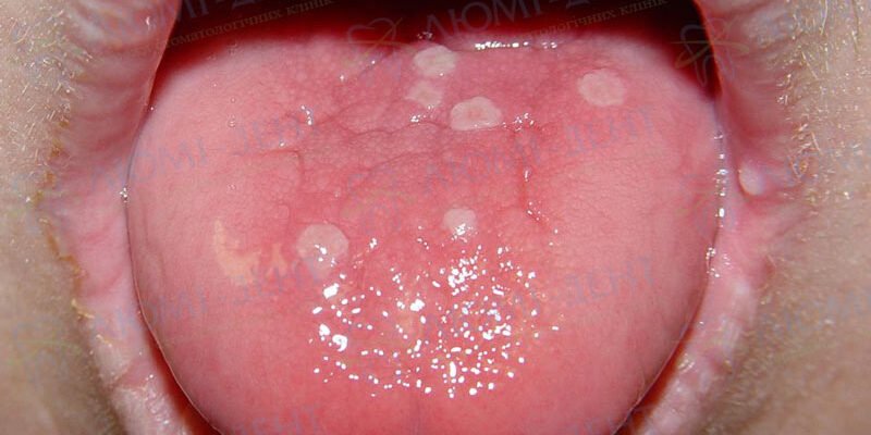 Ефективні народні методи лікування прища на язиці: перевірені засоби