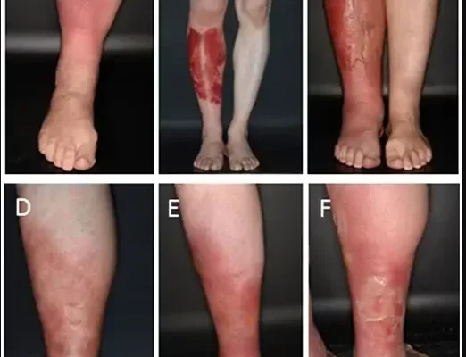 Сучасні методи лікування бешихи: ефективні рішення для здоров’я