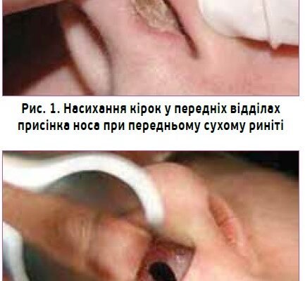 Сухість в носі: ефективні народні методи лікування для полегшення