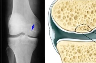 Хвороба Кеніга: як впливає на інвалідність і які є рішення?