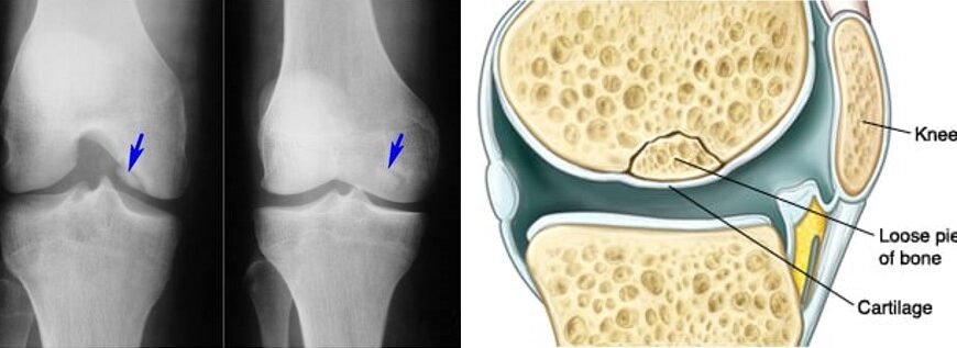 Хвороба Кеніга: як впливає на інвалідність і які є рішення?