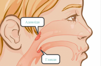 Аденоїди у дитини: симптоми, діагностика та ефективне лікування