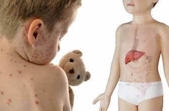 Висипка на животі у дитини: причини, симптоми та лікування.