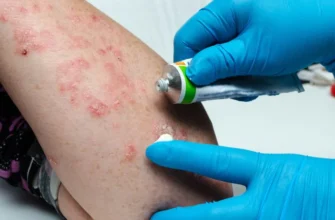 Грибкові інфекції: причини, симптоми та ефективні методи лікування