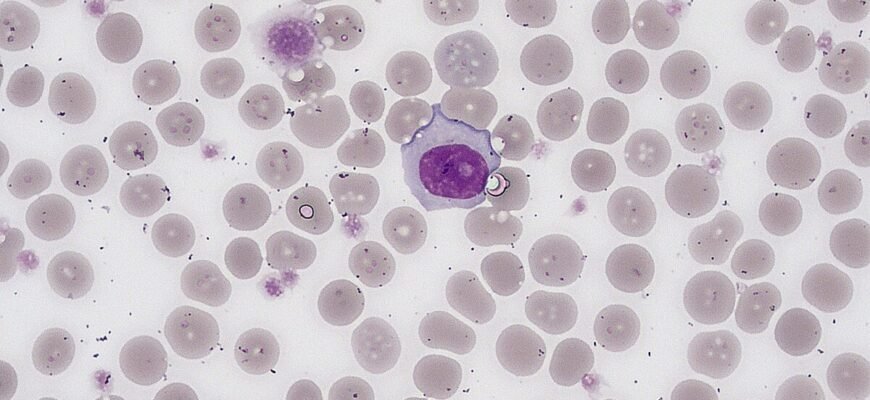 Підвищені тромбоцити у дитини: причини, симптоми та лікування Підвищені тромбоцити у дитини: причини, симптоми та лікування