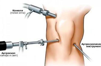 Чи можна ходити при розриві меніска: що радять медики? Чи можна ходити при розриві меніска: що радять медики?