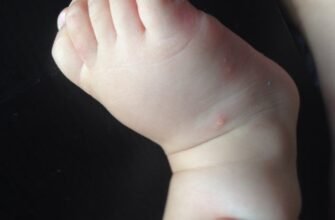 Висипка у дитини на ногах: причини, симптоми та лікування