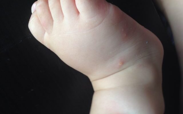 Висипка у дитини на ногах: причини, симптоми та лікування Висипка у дитини на ногах: причини, симптоми та лікування