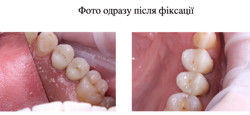 Чи можна змінити колір коронки: огляд можливостей та методів