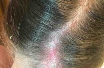 Грибок на голові у дитини: причини, симптоми та лікування