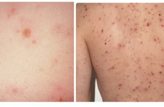 Які прищі при вітрянці: опис, симптоми та етапи розвитку