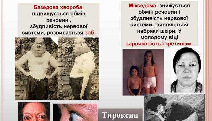 Базедова хвороба розвивається із-за порушень роботи щитовидної залози