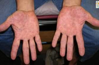 Висип на долонях у дитини: причини та методи лікування