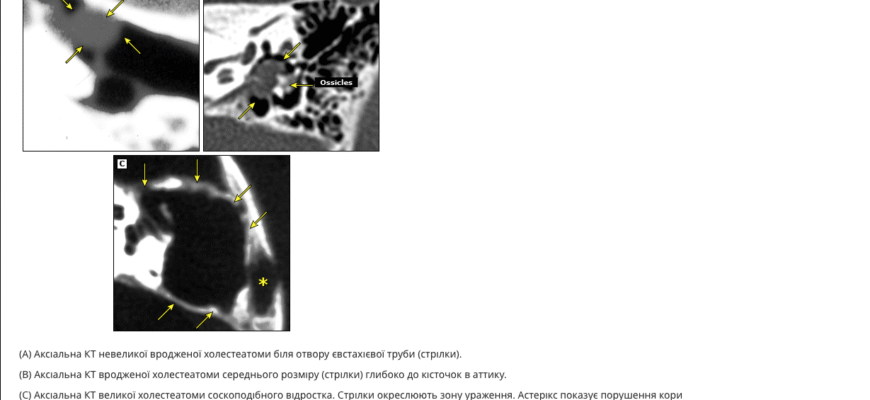 Які є найважливіші потенційні ускладнення хронічного отиту?