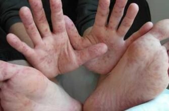 Вірусна інфекція у дитини: симптоми та діагностика захворювання