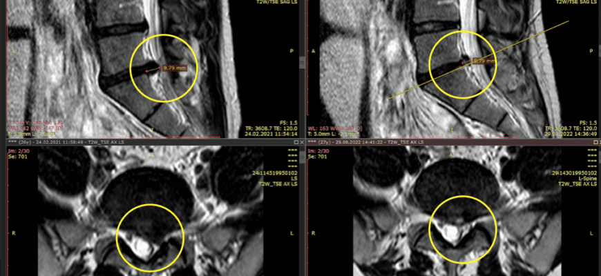 Дегенеративні зміни шийного відділу хребта: причини та профілактика