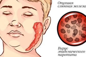 Свинка хвороба: фото симптомів і рекомендації лікування