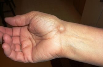 Підшкірна гулька на шиї у дитини: причини та лікування проблеми