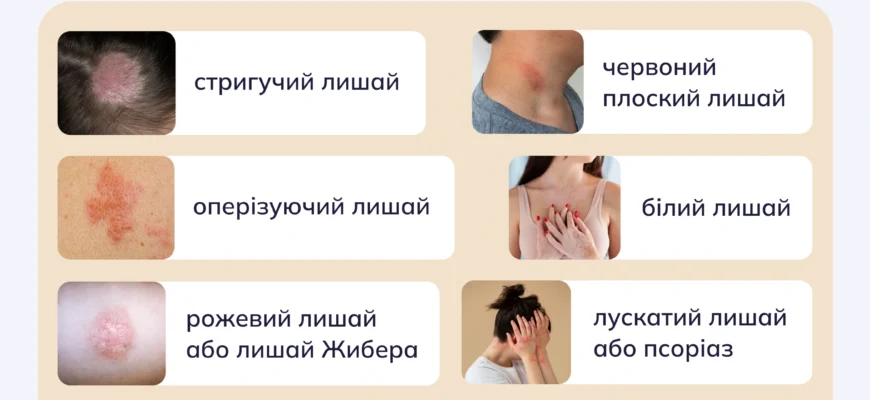 Лишай у дитини: як розпізнати симптоми та ефективно лікувати