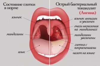 Ангіна у дитини: симптоми, лікування та профілактика