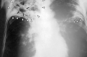 Вогнищеві зміни в легенях: причини, діагностика та лікування