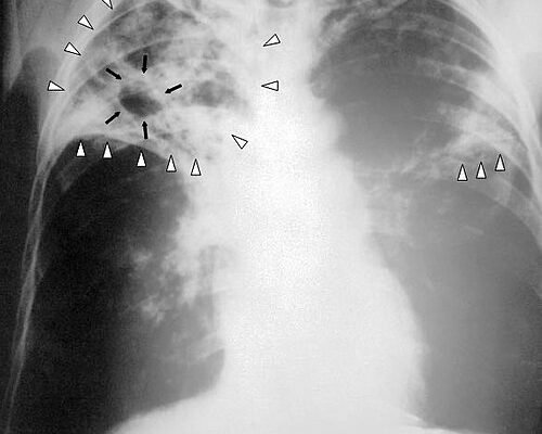 Вогнищеві зміни в легенях: причини, діагностика та лікування