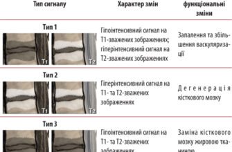 Зміни по типу Modic 1: причини, симптоми та методи лікування