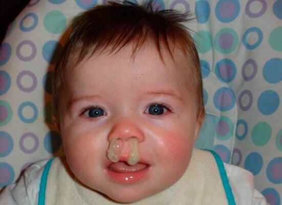 Причини та лікування густих зелених соплів у дитини