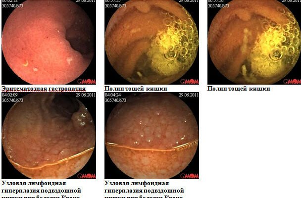 Хвороба Крона: перші симптоми, які варто знати для діагностики