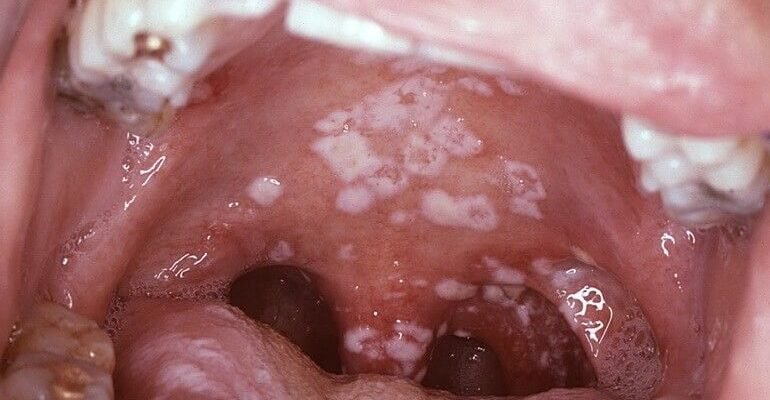 Інфекції ротової порожнини: симптоми, причини та лікування