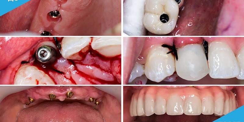 Що таке імпланти: повний гід по використанню та перевагам