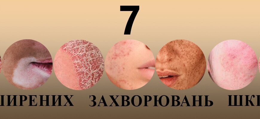 Які є хвороби шкіри: перелік частих дерматологічних проблем