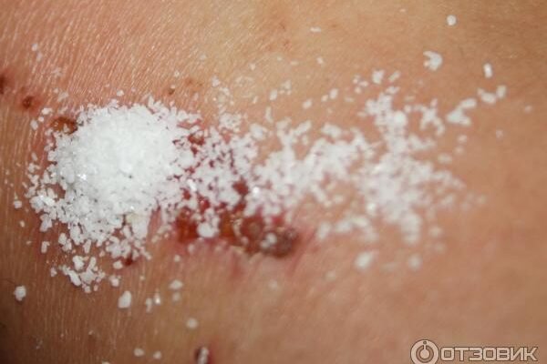 Чи можна засипати рану стрептоцидом: безпечність та ефективність Чи можна засипати рану стрептоцидом: безпечність та ефективність