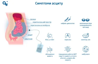 Що таке асцит: Причини, симптоми та методи лікування асциту